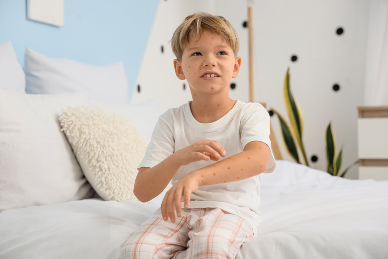 Инфекционист раскрыл смертельную опасность «ветряночных вечеринок»