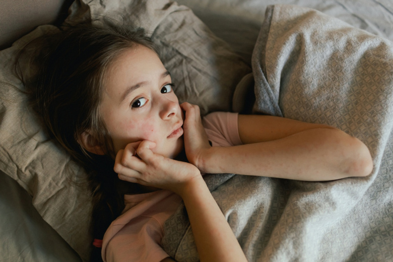 Терапевт предупредил о смертельной опасности скарлатины для взрослых